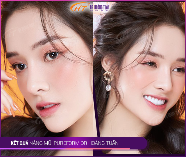 Kết quả nâng mũi Pureform tại Thẩm mỹ Hoàng Tuấn